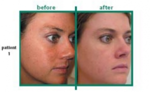 AFA facial peel