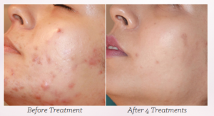 mesotherapy microneedling